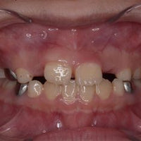 Warning: Diastema (Gap) in Children Aged 6–12 – Watch Out for the 