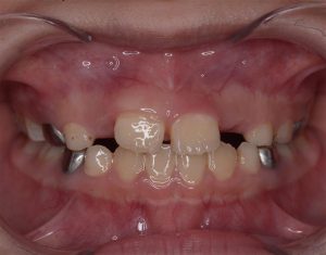 Warning: Diastema (Gap) in Children Aged 6–12 – Watch Out for the "Hidden Culprit": Supernumerary Teeth!