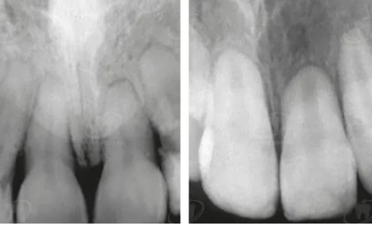Tooth Resorption: When the Protective "Wall" is Destroyed