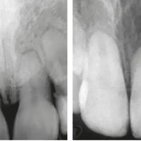 Tooth Resorption: When the Protective 